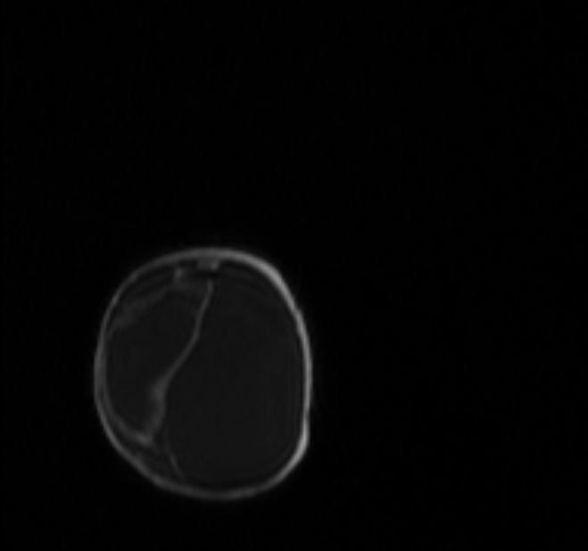 Chiari III malformation with occipital encephalocele (Radiopaedia 79446-92559 Coronal T1 C+ mpr 70).jpg