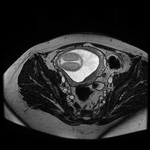 Chiari II malformation - fetal MRI (Radiopaedia 68099-77581 Axial Fiesta 46).jpg