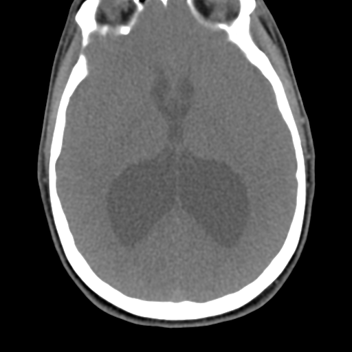Chiari I malformation and obstructive hydrocephalus (Radiopaedia 41185-43981 D 10).png