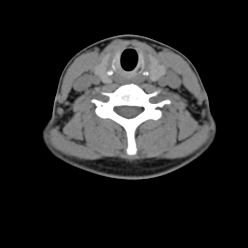 File:Chiari I malformation and obstructive hydrocephalus (Radiopaedia 41185-43981 D 63).png
