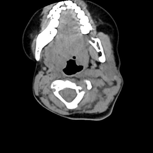 Chiari I with syrinx and skull base anomalies (Radiopaedia 89444-106412 Axial non-contrast 62).jpg
