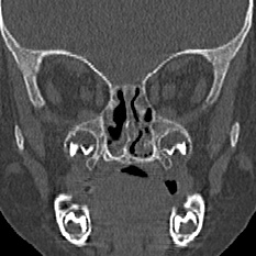 Choanal atresia (Radiopaedia 88525-105975 Coronal bone window 54).jpg