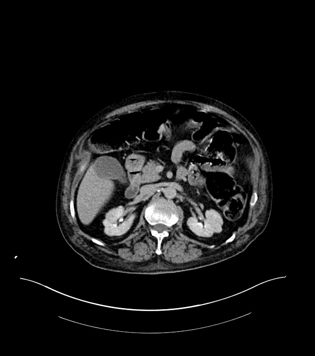 Cholangiocarcinoma with cerebral metastases (Radiopaedia 83519-98629 Axial C+ delayed 42).jpg