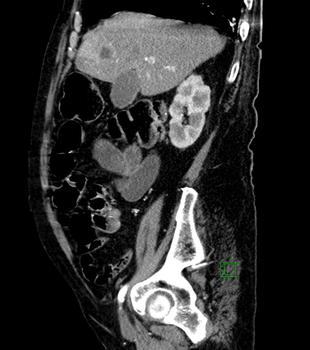 Cholangiocarcinoma with cerebral metastases (Radiopaedia 83519-98629 F 85).jpg