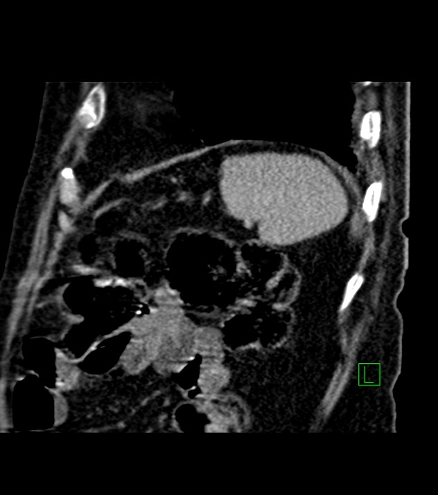 Cholangiocarcinoma with cerebral metastases (Radiopaedia 83519-98629 Sagittal C+ delayed 21).jpg
