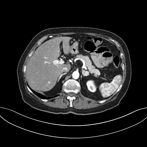 Cholecystoduodenal fistula due to calculous cholecystitis with gallstone migration (Radiopaedia 86875-103077 A 21).jpg