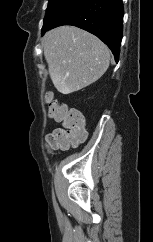 Cholecystoduodenal fistula due to calculous cholecystitis with gallstone migration (Radiopaedia 86875-103077 C 51).jpg