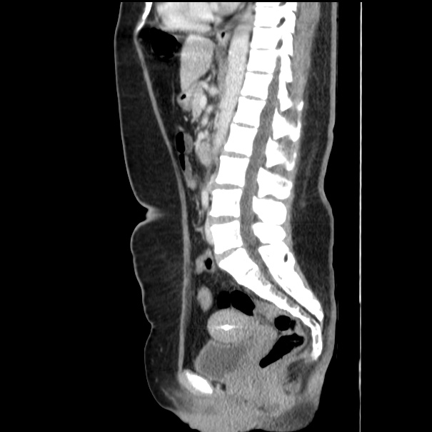 Choledocholithiasis on CT and MRI (Radiopaedia 24825-25087 D 34).jpg