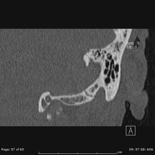 Cholesteatoma - external auditory canal (Radiopaedia 88452-105096 Coronal bone window 57).jpg