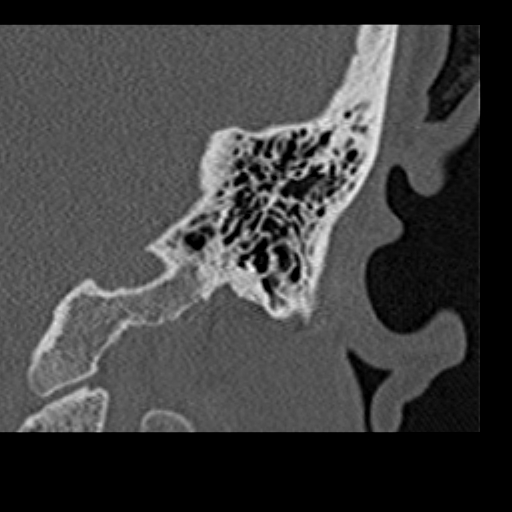 File:Cholesteatoma of the external ear (Radiopaedia 16540-16225 Coronal bone window 23).jpg