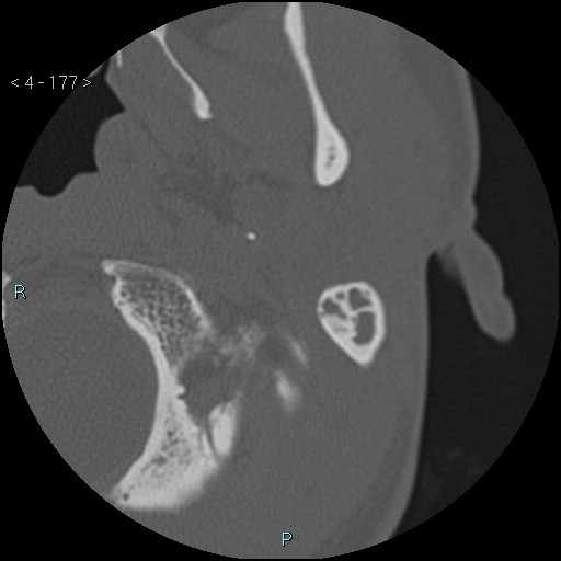 Cholesterol granuloma of the petrous apex (Radiopaedia 64358-73141 Axial bone window 85).jpg