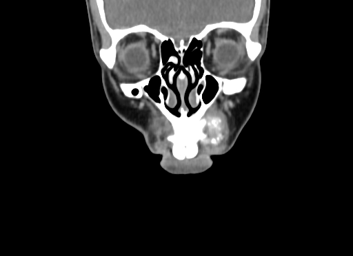 File:Chondroblastic osteosarcoma (Radiopaedia 67363-76741 D 19).jpg