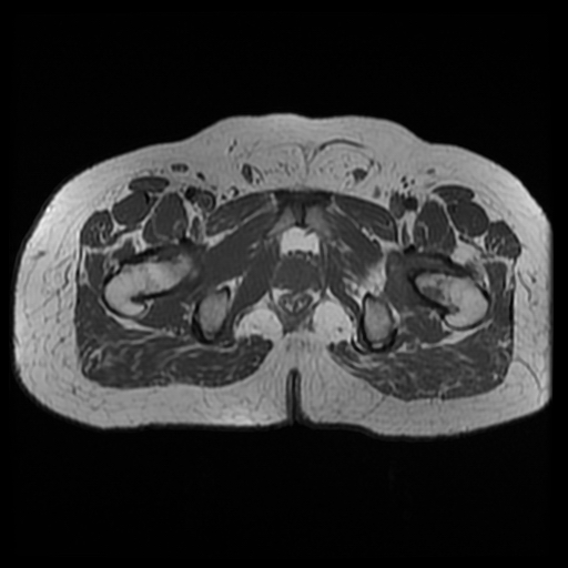 File:Chondroblastoma (Radiopaedia 12264-12564 Axial T1 1).jpg