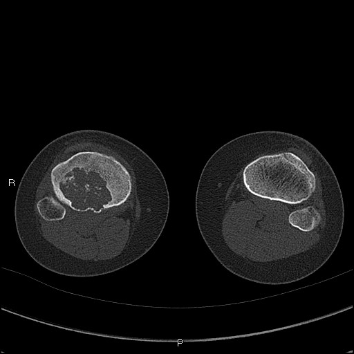 Chondroblastoma (Radiopaedia 62721-71030 Axial bone window 69).jpg