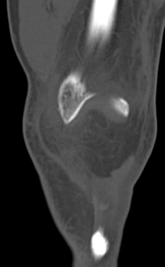 Chondrocalcinosis (Radiopaedia 82862-97173 Coronal bone window 21).jpg