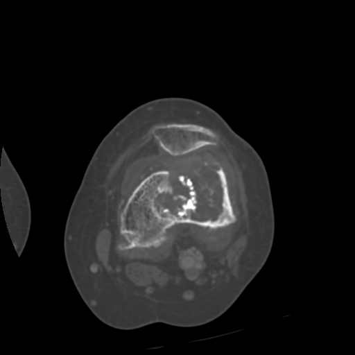 Chondrosarcoma - femur (Radiopaedia 64187-72954 Axial bone window 34).jpg