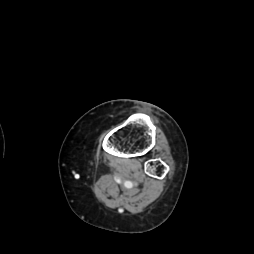 Chondrosarcoma - femur (Radiopaedia 64187-72954 Axial with contrast 76).jpg