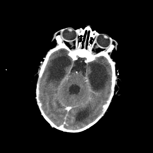Choroid plexus papilloma (Radiopaedia 63946-72698 Axial with contrast 19).jpg