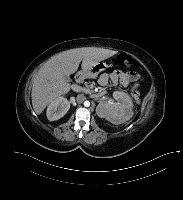 Chromophobe renal cell carcinoma (Radiopaedia 84239-99519 B 47).jpg