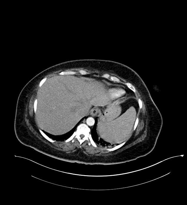Chromophobe renal cell carcinoma (Radiopaedia 84239-99519 B 9).jpg