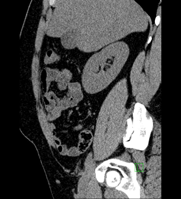 Chromophobe renal cell carcinoma (Radiopaedia 84286-99573 C 130).jpg
