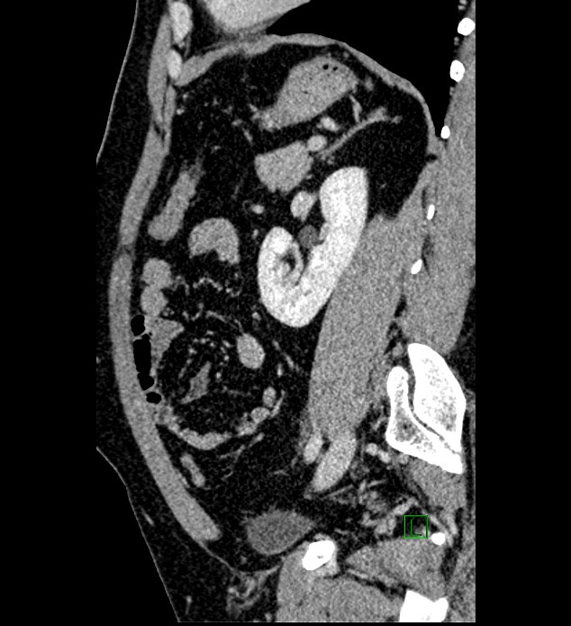 Chromophobe renal cell carcinoma (Radiopaedia 84286-99573 I 60).jpg