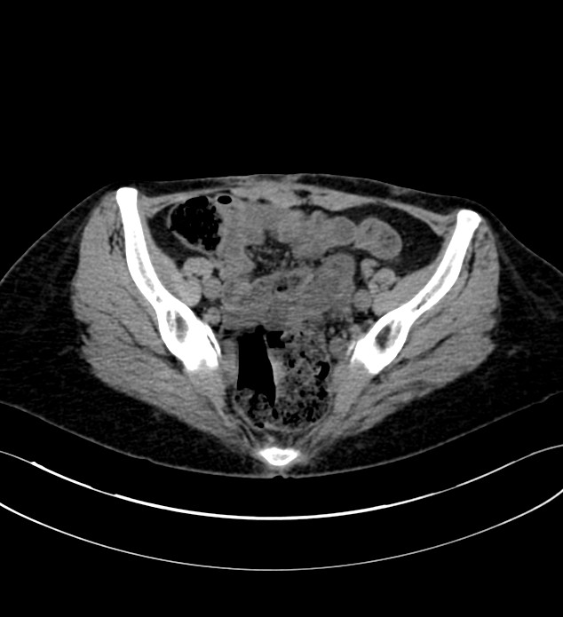 Chromophobe renal cell carcinoma (Radiopaedia 84290-99582 Axial non-contrast 121).jpg