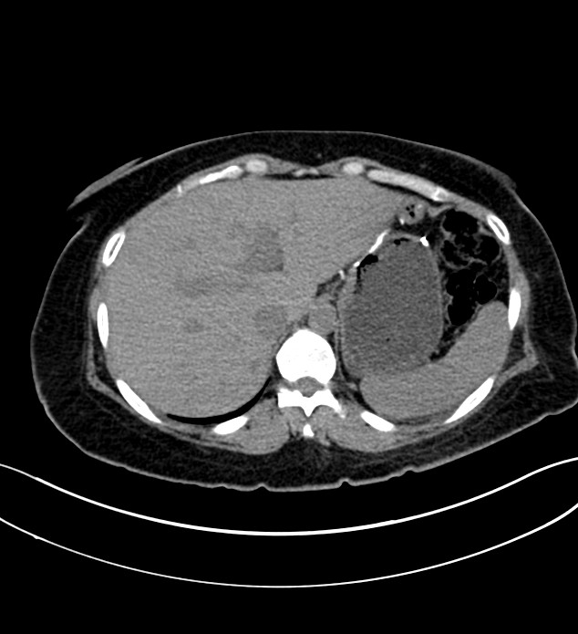 Chromophobe renal cell carcinoma (Radiopaedia 84290-99582 Axial non-contrast 30).jpg