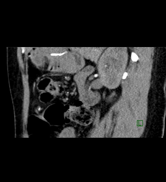 Chromophobe renal cell carcinoma (Radiopaedia 84290-99582 D 35).jpg
