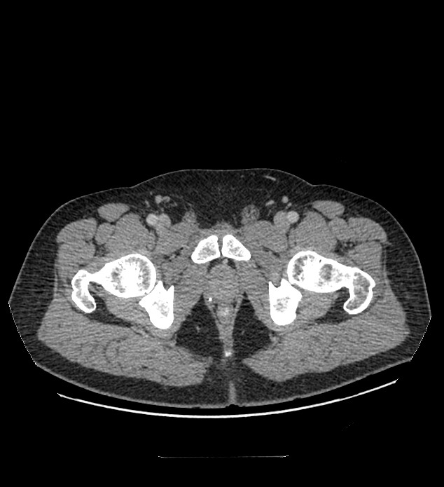 Chromophobe renal cell carcinoma (Radiopaedia 84337-99644 C 135).jpg