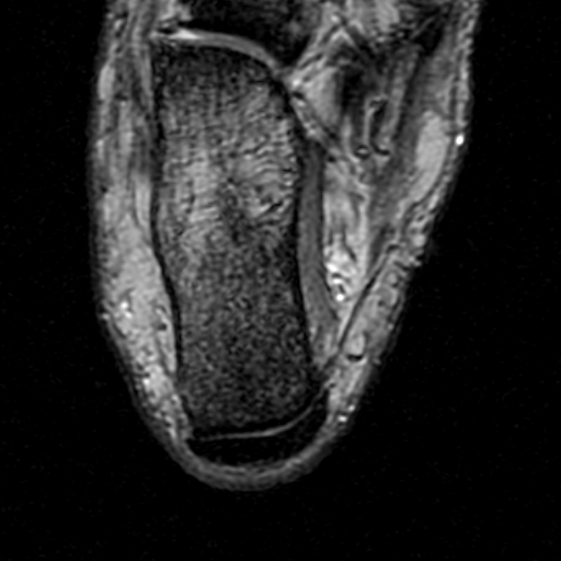 File:Chronic Achilles tendon rupture (Radiopaedia 15262-15100 Axial Gradient Echo 23).jpg