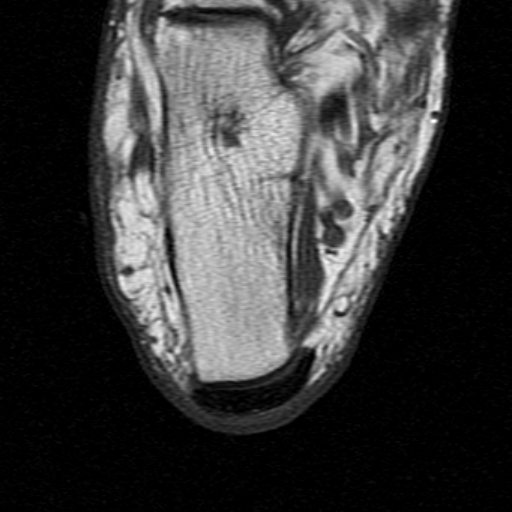 File:Chronic Achilles tendon rupture (Radiopaedia 15262-15100 Axial T1 23).jpg