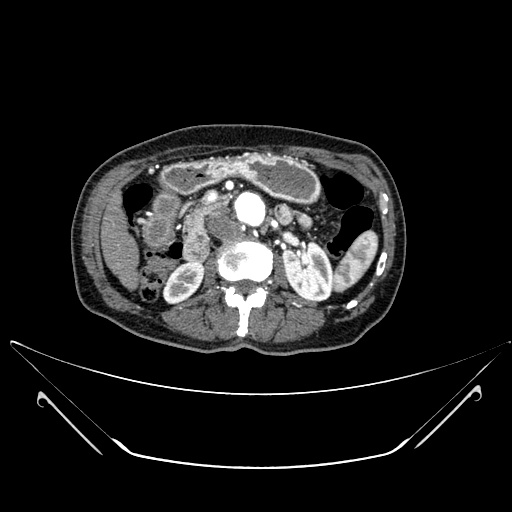 File:Chronic contained rupture of abdominal aortic aneurysm with extensive erosion of the vertebral bodies (Radiopaedia 55450-61901 A 20).jpg