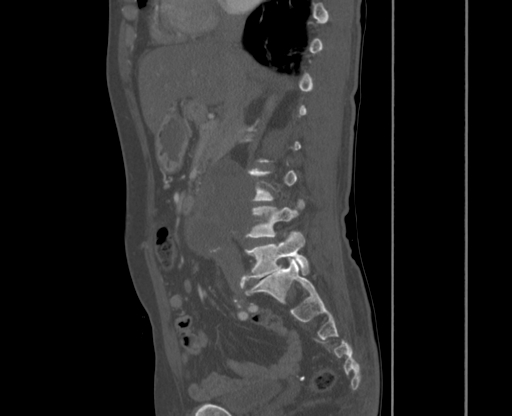 File:Chronic contained rupture of abdominal aortic aneurysm with extensive erosion of the vertebral bodies (Radiopaedia 55450-61901 Sagittal bone window 3).jpg