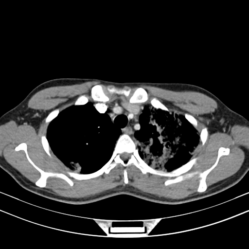 Chronic eosinophilic pneumonia (Radiopaedia 39331-41587 Axial C+ delayed 32).png