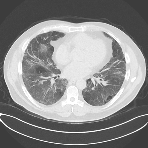Chronic hypersensitivity pneumonitis (Radiopaedia 48107-52922 Axial lung window 37).png