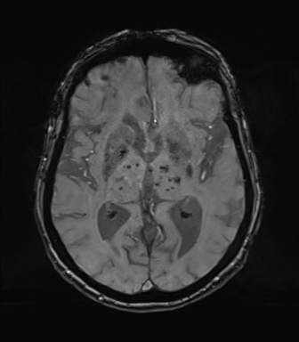 Chronic hypertensive encephalopathy (Radiopaedia 72844-83495 Axial SWI magnitude 42).png