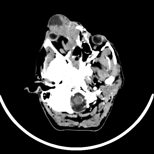 Chronic invasive fungal sinusitis with intraorbital and intracranial extension (Radiopaedia 56387-63046 B 77).jpg