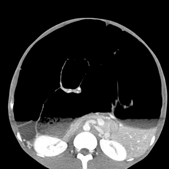 Chronic large bowel pseudo-obstruction (Radiopaedia 43181-46492 A 82).jpg