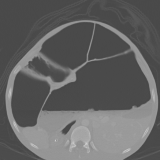 Chronic large bowel pseudo-obstruction (Radiopaedia 43181-46492 Axial bone window 65).jpg