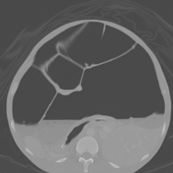 Chronic large bowel pseudo-obstruction (Radiopaedia 43181-46492 Axial bone window 71).jpg
