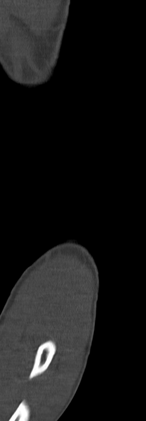 Chronic osteomyelitis of the distal humerus (Radiopaedia 78351-90971 Sagittal bone window 26).jpg