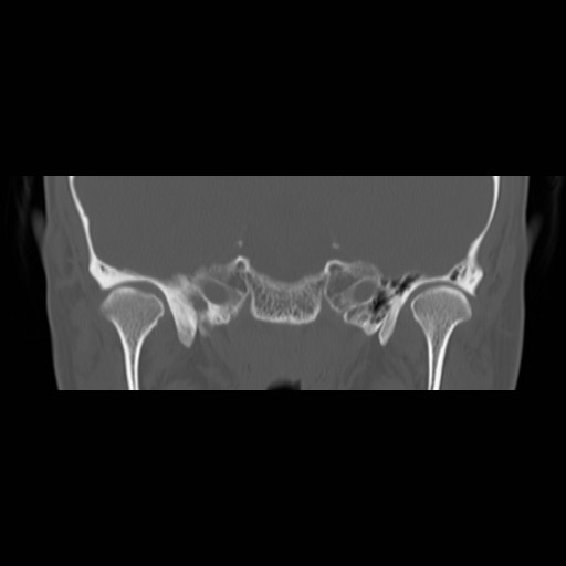 File:Chronic otomastoiditis (Radiopaedia 27138-27309 Coronal bone window 3).jpg