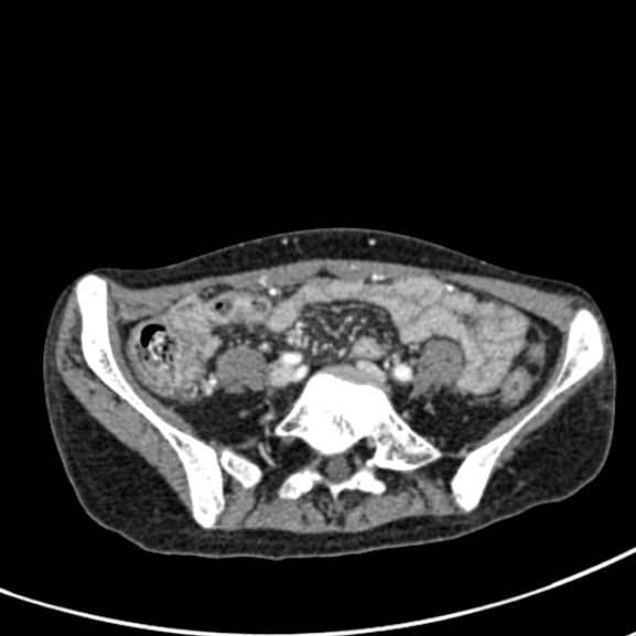 Chronic pancreatitis (Radiopaedia 55405-61846 A 74).jpg