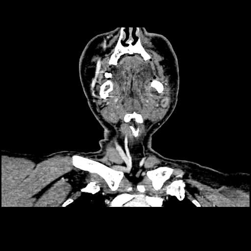 File:Chronic submandibular abscess (Radiopaedia 21738-21718 B 9).jpg