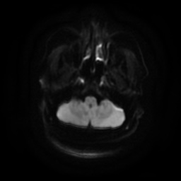 Chronic submandibular sialadenitis (Radiopaedia 61852-69885 Axial DWI 5).jpg