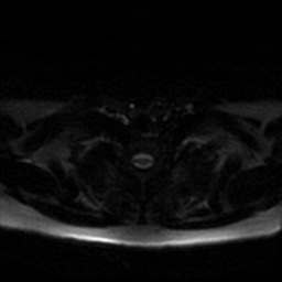 File:Chronic submandibular sialadenitis (Radiopaedia 61852-69885 Axial DWI 59).jpg
