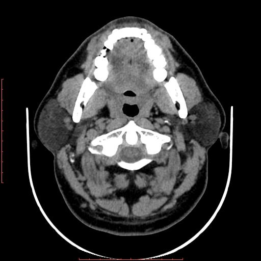 Chronic submandibular sialolithiasis (Radiopaedia 69817-79814 Axial non-contrast 63).jpg