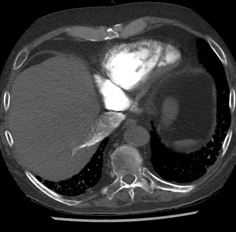Chronic thromboembolic pulmonary disease (Radiopaedia 90694-108119 Axial C+ CTPA 78).jpg