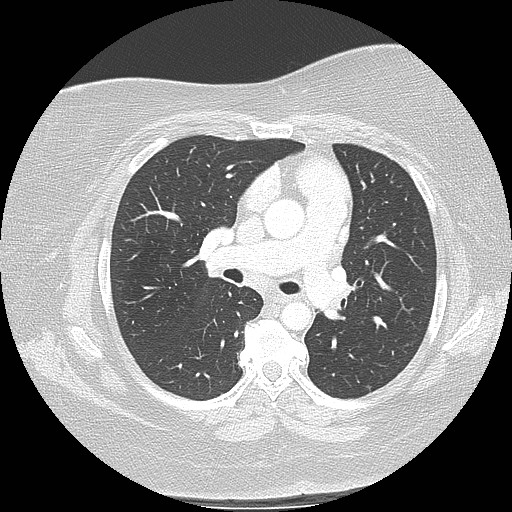 Cicatrisation collapse (Radiopaedia 17405-17089 lung window 50).jpg